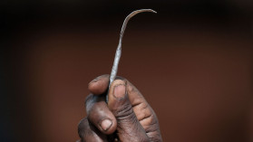 Female genital mutilation(FGM)